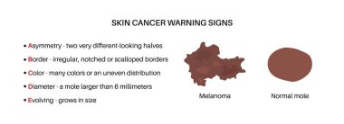 Melanoma ve normal ben karşılaştırması, cilt kanseri uyarısı, ABCDE kural posteri. Kötü huylu tümör melanosit hücreleri deri katmanlarına dönüşüyor. Onkoloji önleme tıbbi düz vektör çizimi