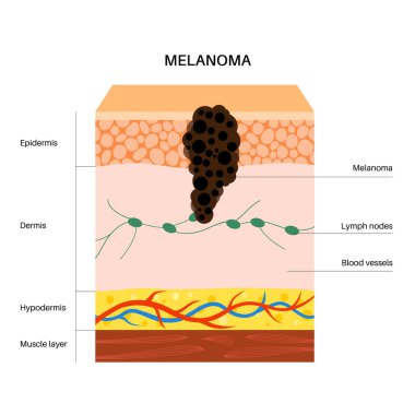 Melanoma anatomik poster, cilt kanseri gelişimi. Üst deriden diğer iç organlara kadar deri tabakalarında kötü huylu tümör oluşmuş. Dermatoloji kliniğinde teşhis ve tedavi düz vektör