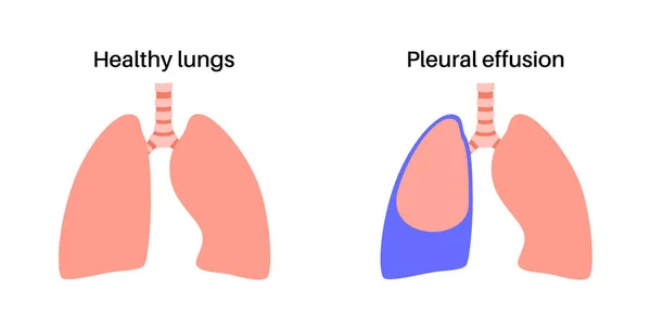 胸腔积液疾病 肺和胸腔组织层之间的流体 不同的呼吸 人体内部器官不健康 呼吸系统医疗媒介说明 — 图库矢量图片