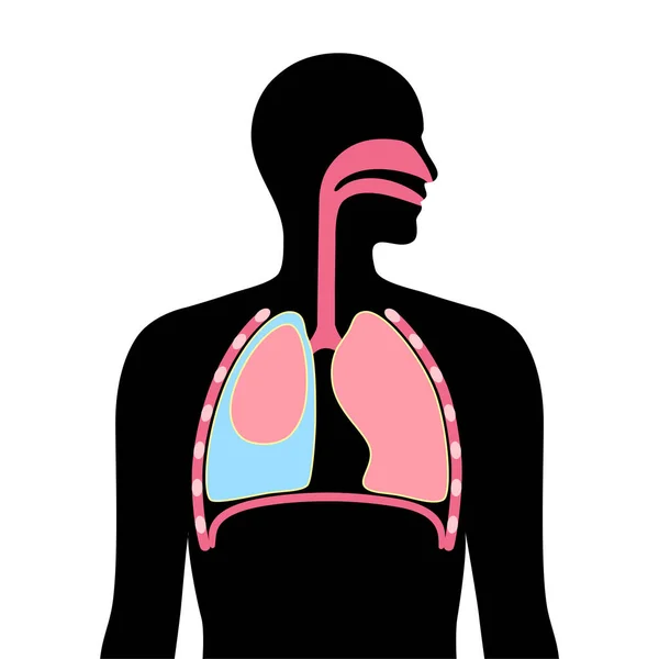 Choroba Wysiękowa Opłucnej Płyn Między Warstwami Tkanki Płucach Jamie Klatki — Wektor stockowy
