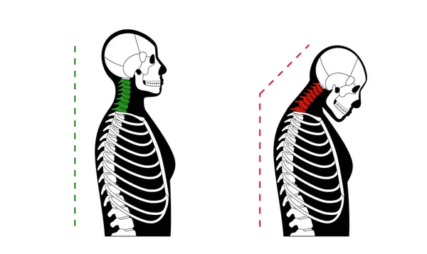 颈椎形变图 颈部痉挛 脊柱疼痛 肩膀僵硬和紧绷 健康脊柱和驼峰在男性体内的医学说明 骨骼轮廓 — 图库矢量图片