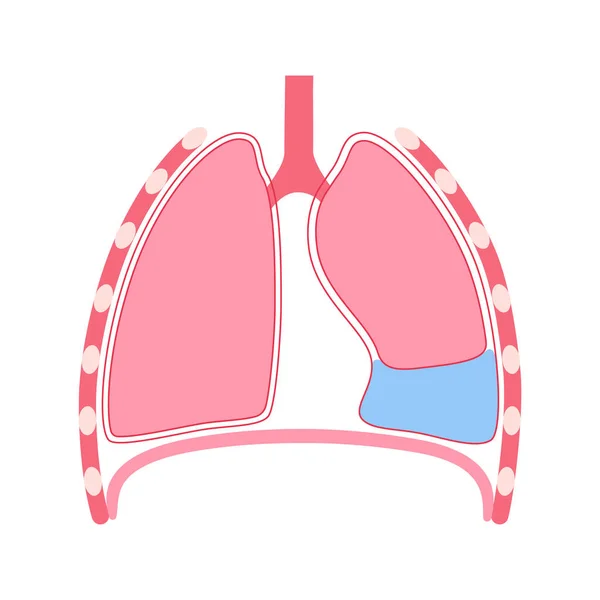 stock vector Pleural effusion disease. Fluid between the layers of tissue in lungs and chest cavity. DIfficult breathing. Unhealthy internal organs in the human body. Respiratory system medical vector illustration