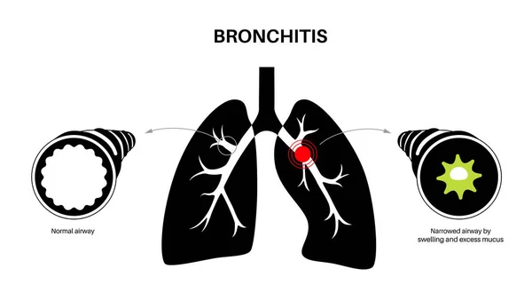 気管支炎の概念 肺の感染症 ブロンチ解剖ポスター 刺激され 炎症を起こした気道 呼吸困難 胸の痛みと肺のフラットベクトル図の粘液 — ストックベクタ