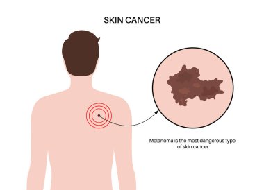 Bir adamın sırtında Melanoma, cilt kanseri gelişimi. Kötü huylu tümör teşhisi ve tedavisi. Pigment melanosit hücreleri üretiyor. Laboratuvar düz vektör illüstrasyonunda dermatoloji incelemesi