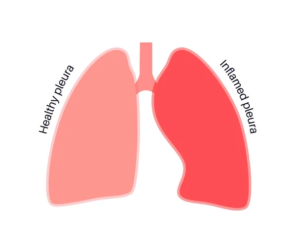 Concept Maladie Pleurale Inflammation Pulmonaire Douleur Thoracique Aiguë Pendant Respiration — Image vectorielle