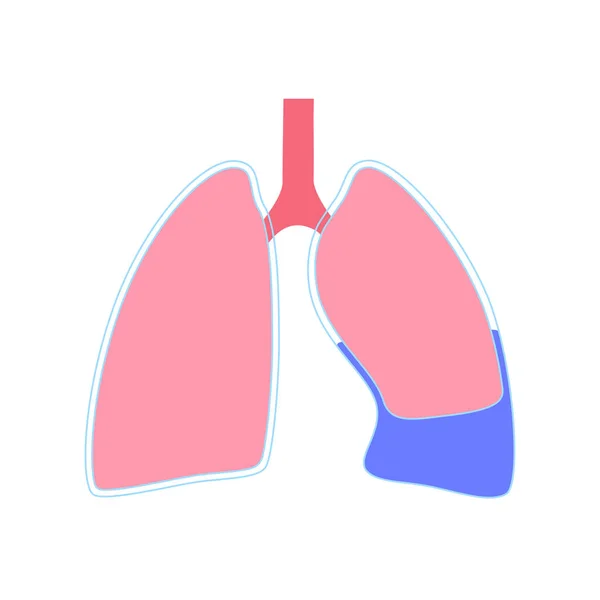 Plevral Efüzyon Hastalığı Akciğer Göğüs Boşluğundaki Doku Katmanlarının Arasında Sıvı — Stok Vektör