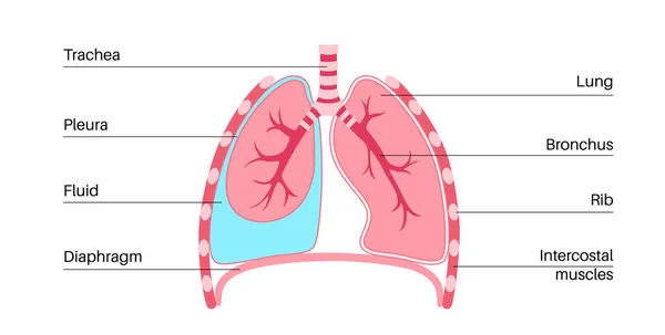 Pleurální Výpotek Tekutina Mezi Vrstvami Tkáně Plicích Hrudní Dutině Dýchání — Stockový vektor