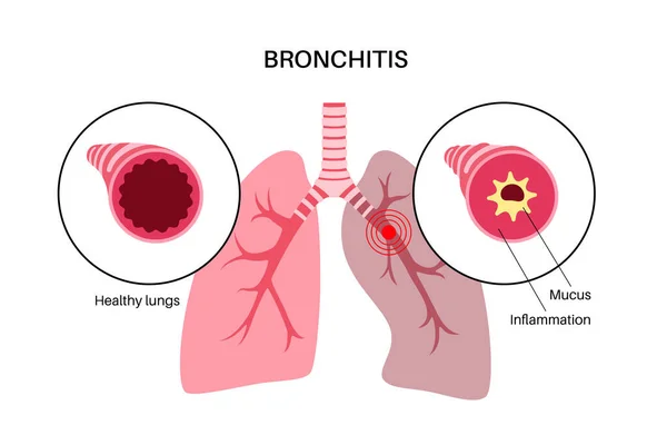 Концепция Бронхита Инфекция Легких Анатомический Плакат Бронки Раздражение Отек Воспаление — стоковый вектор