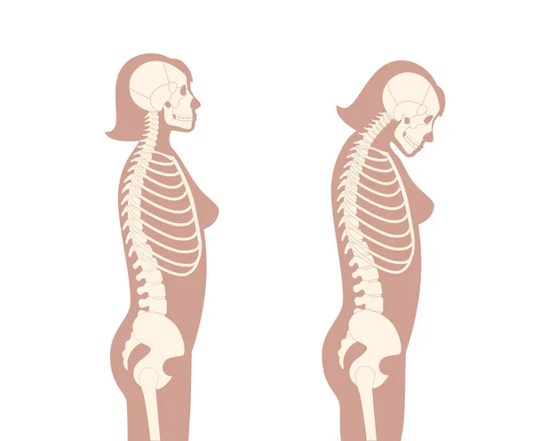 Diagrama Deformación Las Vértebras Cervicales Espasmos Cuello Dolor Columna Vertebral — Vector de stock
