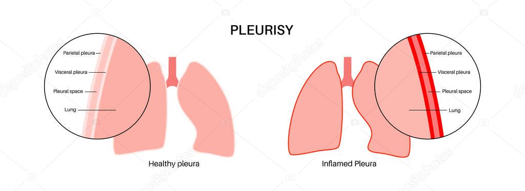 Concepto Enfermedad Pleuresía Inflamación Los Pulmones Dolor Torácico ...