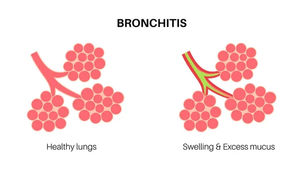 Zapalenie Oskrzeli Zakażenie Płuc Plakat Anatomiczny Bronchiego Podrażnione Obrzęk Zapalenie — Wektor stockowy