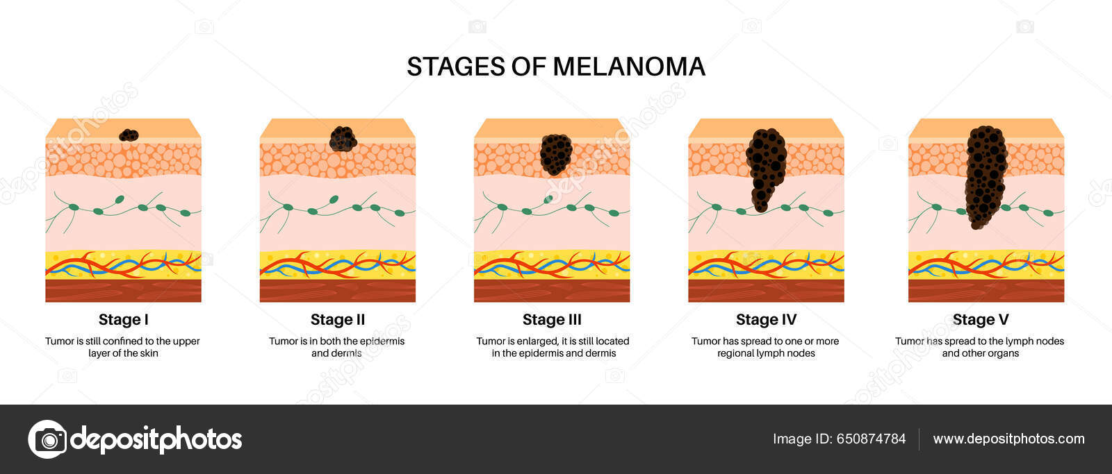 estadios-del-desarrollo-progresi-n-del-c-ncer-piel-melanoma-crecimiento