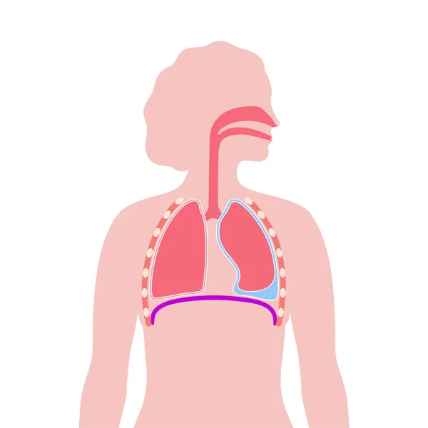 Keuhkopussin Nestekertymä Nestettä Keuhkojen Rintaontelon Kudosten Välissä Vaikea Hengittää Epäterveelliset — vektorikuva