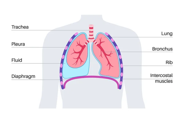 삼출액 질환이야 흉강에 사이에 액체가 인체의 불건전 기관이다 호흡계 — 스톡 벡터