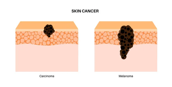 黑色素瘤和癌症解剖 皮肤癌的发展 恶性肿瘤从表皮到其他内脏器官的皮肤层不断增长 皮肤科临床扁平载体的诊断与治疗 — 图库矢量图片