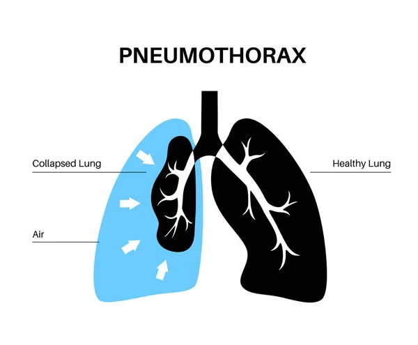 Pneumothorax Ziekte Vlakke Vector Instortte Long Medische Poster Lucht Ruimte — Stockvector