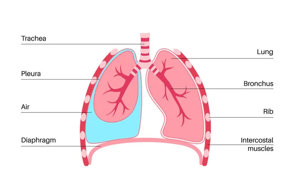 Пневмоторакс Хвороба Плоский Вектор Згорнутий Медичний Плакат Легень Повітря Просторі — стоковий вектор