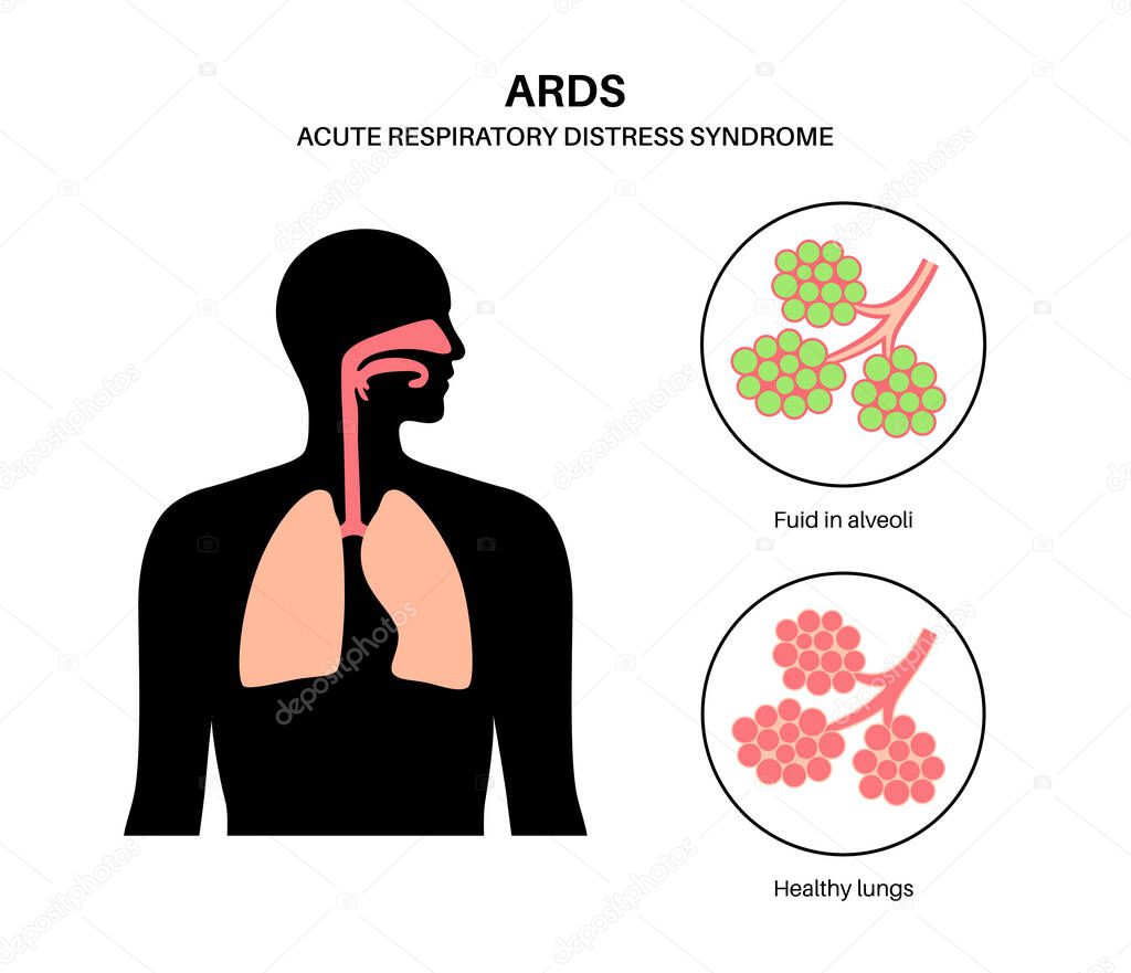 Síndrome De Dificultad Respiratoria Aguda. Los Pulmones No Tienen ...