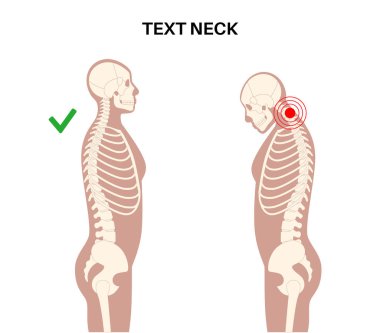 Diagram of deformation of the cervical vertebrae. Neck spasm, pain in spine, stiffness and tightness in shoulders. Healthy spine and hump in male body medical vector illustration, skeleton silhouette. clipart