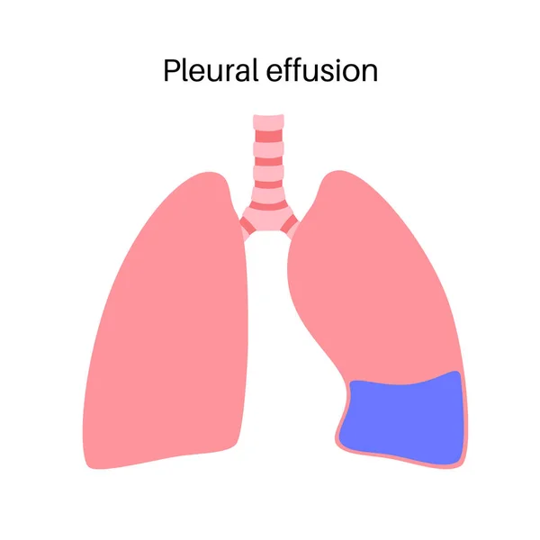 胸水疾患 肺および胸腔内の組織の層間の流体 呼吸が難しい 人体内の不健康な内臓 呼吸器系医療用ベクターイラスト — ストックベクタ