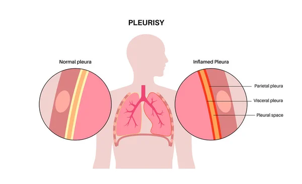 胸膜炎的概念 肺部发炎 呼吸时胸部剧痛 人体内部器官不健康 胸腔问题 呼吸系统海报病媒图解 — 图库矢量图片