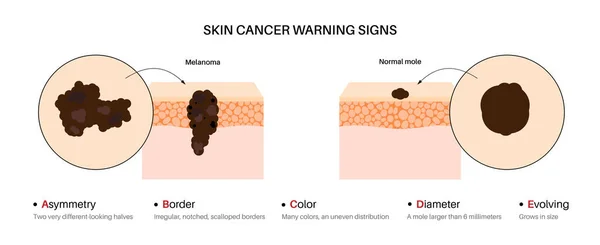 Melanom Och Normal Mullvadsjämförelse Varningstecken Hudcancer Abcde Regler Affisch Maligna — Stock vektor