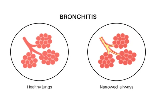 Bronchitis Concept Longinfectie Bronchi Anatomische Poster Geïrriteerd Zwelling Ontstoken Luchtwegen — Stockvector