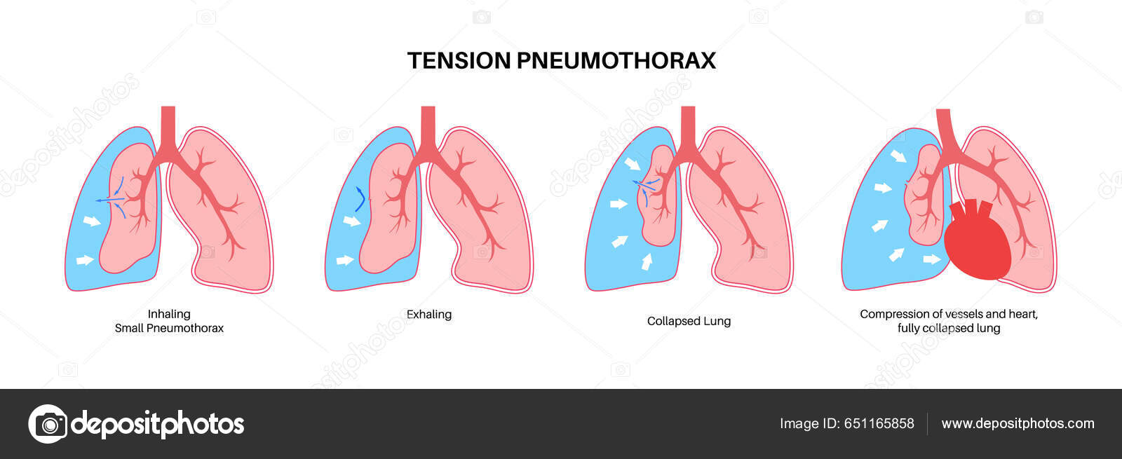 Image vectorielle Pneumothorax Tension Réduire Quantité Sang ...