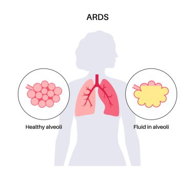Akut solunum yetmezliği sendromu. Ciğerler yeterli oksijen alamıyor. ARDS tıbbi afişi. Coşkulu, üretici ve fibrotik aşamalar. Sağlıksız iç organlar. Solunum sistemi vektör çizimi