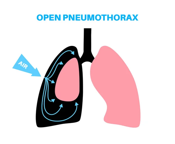 Pneumothorax Sjukdom Platt Vektor Kollapsade Lungmedicinska Affischer Luft Utrymmet Mellan — Stock vektor
