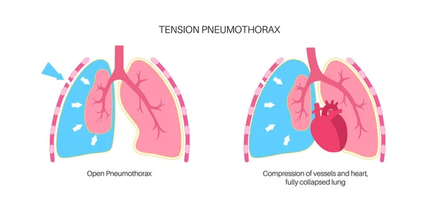 Spanning Pneumothorax Ziekte Het Verminderen Van Hoeveelheid Bloed Keerde Terug — Stockvector