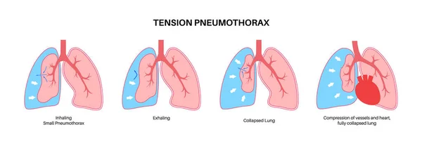 Enfermedad Por Neumotórax Por Tensión Reducir Cantidad Sangre Devuelta Corazón — Vector de stock