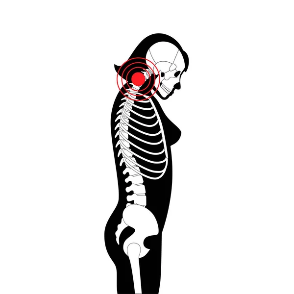 Diagram Deformation Cervical Vertebrae Neck Spasm Pain Spine Stiffness Tightness — Stock Vector