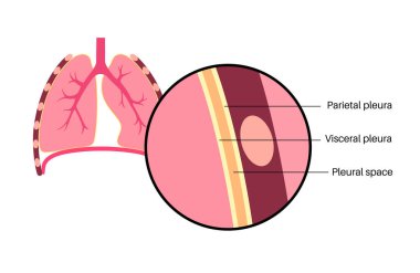 Plevra anatomisi konsepti. Göğüs boşluğu tıbbi afişi. İnsan vücudunda hatıra dokusu. Solunum sistemi şeması. Pulmoner pleurae diyagramı. Akciğerler, soluk borusu, bronz ve kaburga düz vektör çizimi.