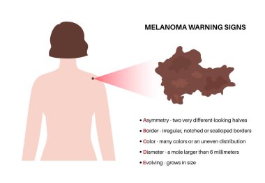 Melanoma uyarı işaretleri. Cilt kanseri için ABCDE kuralı. Asimetrik şekil, düzensiz sınır, birçok renk, büyük çaplı, mol boyutu gelişen. Onkoloji önleme tıbbi poster düz vektör çizimi.