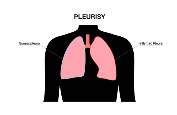 胸膜炎的概念 肺部发炎 呼吸时胸部剧痛 人体内部器官不健康 胸腔问题 呼吸系统海报病媒图解 — 图库矢量图片