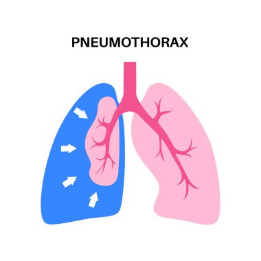 Pnömotoraks hastalığı düz taşıyıcı. Çökmüş akciğer tıbbi afişi. Akciğer ve göğüs duvarı arasındaki boşlukta hava var. Göğüs ağrısı, nefes darlığı. Solunum sisteminde sağlıksız iç organlar