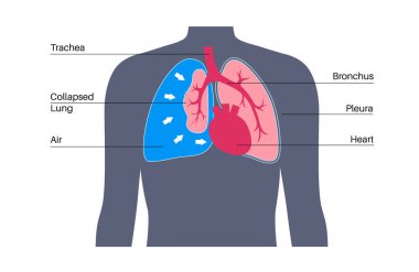 Tansiyon pnömotoraks hastalığı. Kalbe geri gelen kan miktarını azaltmak. Akciğer ya da göğüs duvarı yaralanması. Göğüs ağrısı, nefes darlığı. Solunum sistemi vektöründe sağlıksız iç organlar