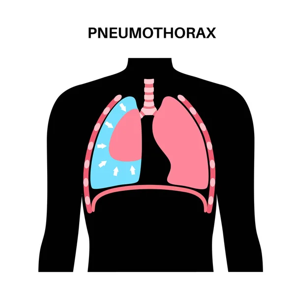 Enfermedad Del Neumotórax Vector Plano Cartel Médico Pulmonar Colapsado Aire — Vector de stock