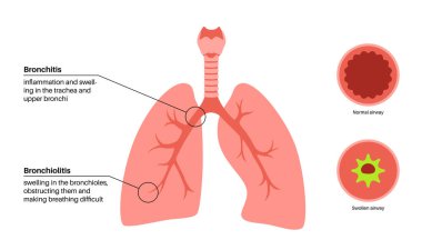 Bronşit ve bronşiyolit, akciğerlerde enfeksiyon. Bronşik anatomik poster. Sinirli, şişmiş ve iltihaplı solunum yolları. Akciğerlerde nefes darlığı, öksürük, göğüs ağrısı ve mukus örnekleri.