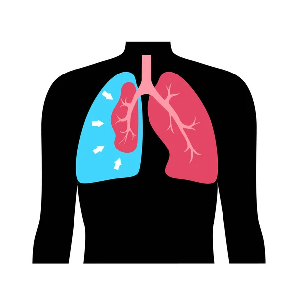 Choroba Odmy Opłucnej Wektor Płaski Upadły Plakat Medyczny Płuc Powietrze — Wektor stockowy