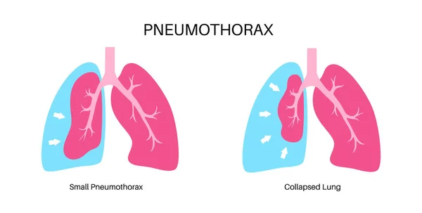 肺炎球菌疾患フラットベクトル 肺医学のポスターが崩壊しました 肺と胸壁の間の空間に空気 胸の痛み 呼吸の不足 呼吸器系の不健康な内臓 — ストックベクタ