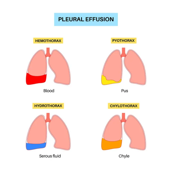 胸水ポスター 肺および胸腔内の組織の層間の流体 一般的な肺疾患 胸の痛み 呼吸困難 呼吸器系の不健康な内臓 — ストックベクタ