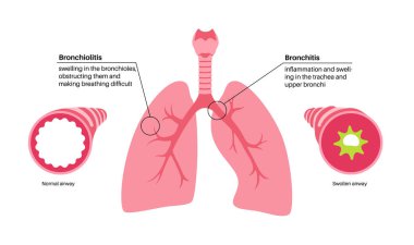 Bronşit ve bronşiyolit, akciğerlerde enfeksiyon. Bronşik anatomik poster. Sinirli, şişmiş ve iltihaplı solunum yolları. Akciğerlerde nefes darlığı, öksürük, göğüs ağrısı ve mukus örnekleri.