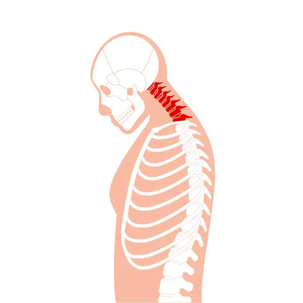 Diagrama Deformación Las Vértebras Cervicales Espasmos Cuello Dolor Columna Vertebral — Vector de stock