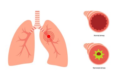 Bronşit kavramı, akciğer enfeksiyonu. Bronşik anatomik poster. Sinirli, şişmiş ve iltihaplı solunum yolları. Nefes darlığı, öksürük, göğüs ağrısı ve akciğerlerde mukus düz vektör çizimi.