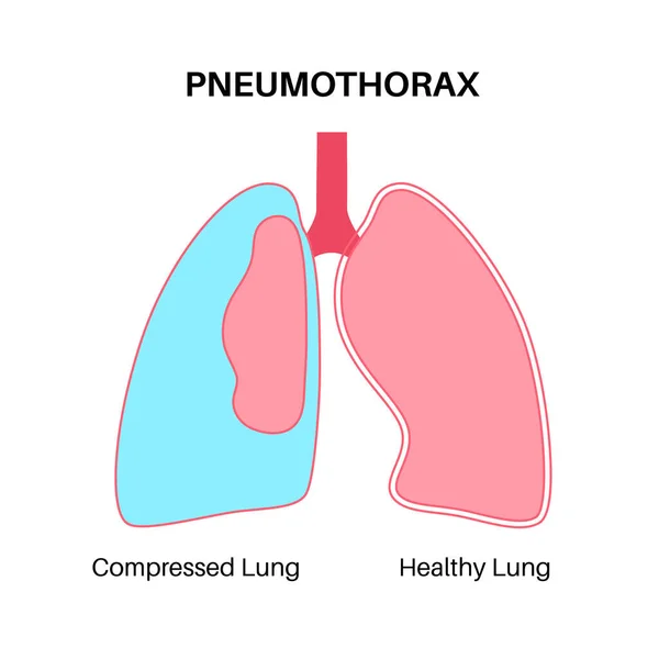 肺炎球菌疾患フラットベクトル 肺医学のポスターが崩壊しました 肺と胸壁の間の空間に空気 胸の痛み 呼吸の不足 呼吸器系の不健康な内臓 — ストックベクタ