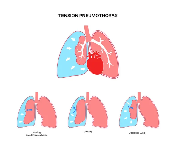 Enfermedad Por Neumotórax Por Tensión Reducir Cantidad Sangre Devuelta Corazón — Archivo Imágenes Vectoriales