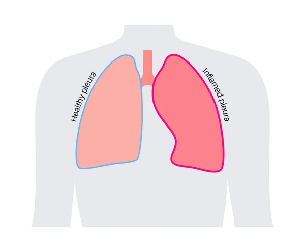 Pojęcie Choroby Opłucnej Zapalenie Płuc Ostry Ból Klatce Piersiowej Podczas — Wektor stockowy