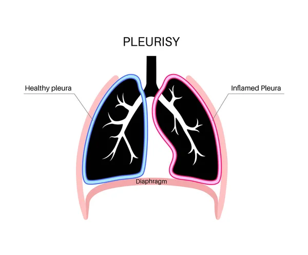 stock vector Pleurisy disease concept. Inflammation in lungs. Sharp chest pain during breathing. Unhealthy internal organs in the human body. Chest cavity problem. Respiratory system poster vector illustration.